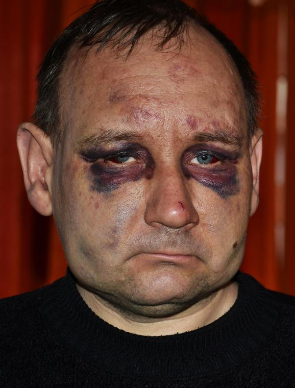 Шахтер из Новогродовки, освобожденный из плена, рассказал, как над ним издевались захватчики (фото, видео)