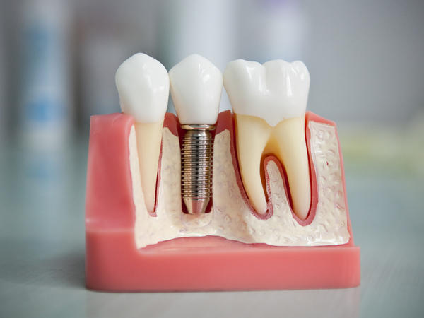 как делают имплантацию зубов