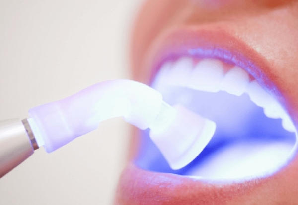 Відбілювання зубів в стоматології