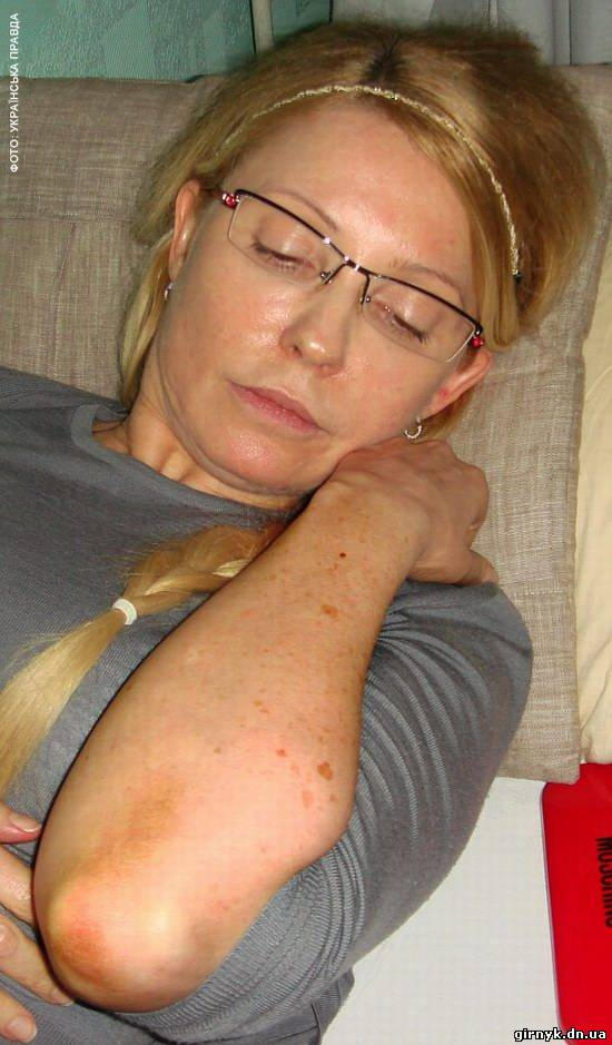 Фото избитой Юлии Тимошенко в колонии