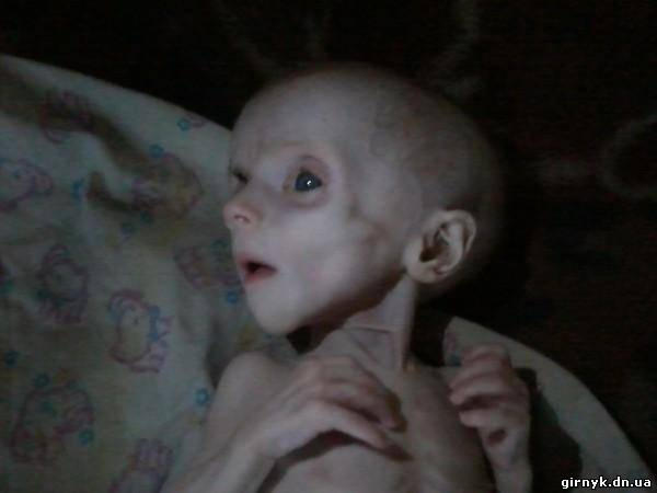 В Донецке мать превратила шестимесячного ребенка в скелет (шокирующие фото)