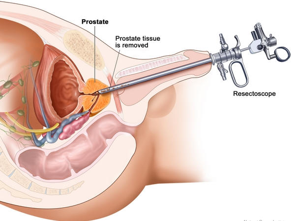 трансуретральная резекция простаты