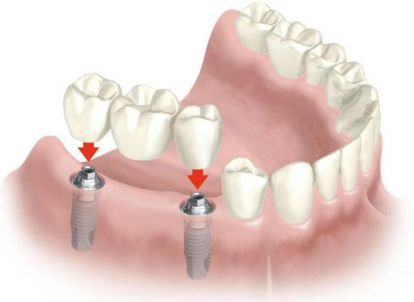 Преимущества имплантации зубов