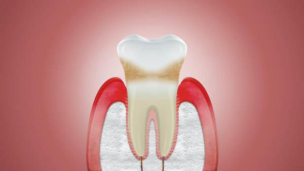 Аутотрансплантація зубів