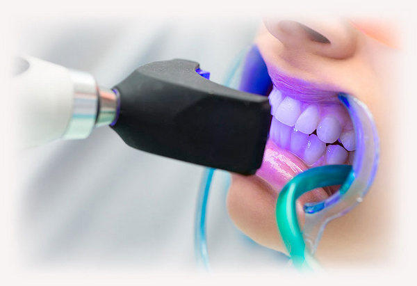 Відбілювання зубів в стоматології